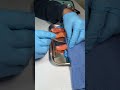 Performing a surgery on a 3D Printed Prosthetic Finger