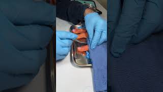 Performing a surgery on a 3D Printed Prosthetic Finger