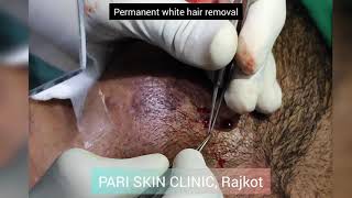 White (grey) hair permanent removal from beard by FUE at PARI SKIN CLINIC, Rajkot, Gujarat.