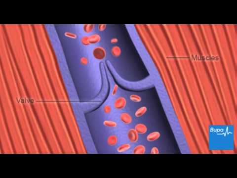 How deep vein thrombosis (DVT) forms