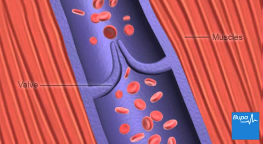 Deep vein thrombosis (DVT): Symptoms and Treatments