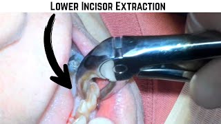 How Bad Can Teeth Get Before Extraction?