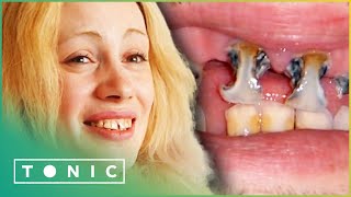 Top 9 How To Fix Rotten Teeth Without Dentist In 2022