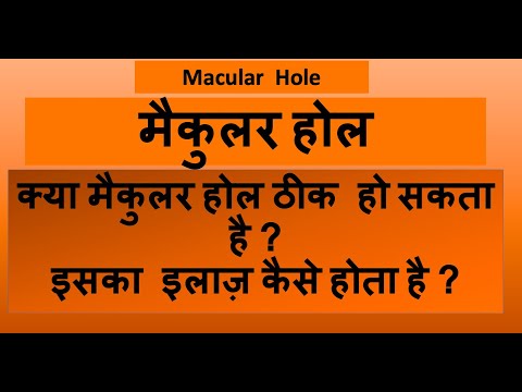 जानिये मैक्युलर होल के इलाज के बारे में - डॉ पुनीत गुप्ता | Macular Hole (मैक्युलर होल) Treatment