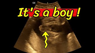 Gender determination, Its a baby boy