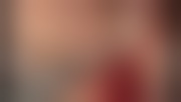 Laparoscopic modified ALPPS procedure for huge hepatocellular carcinoma