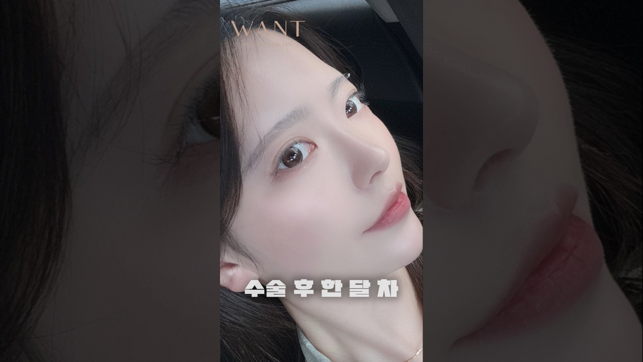 [Вонт гоо сайхны мэс засал] Ганцхан хамрын мэс засал хийлгэсэн ч нүүрний ерөнхий төрх гурван хэмжээстэй болж өөрчлөгдлөө..💖💖💖 Анхны хамар+Хамрын нуруу+Хамрын үзүүр+Донор