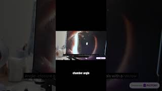 Which medications can dangerously trigger acute angle closure glaucoma
