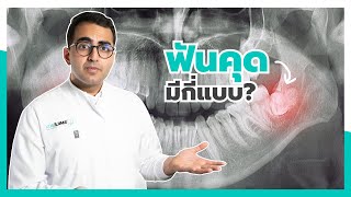 ฟันคุดมีกี่เเบบ⁉️ I หมอฟัน SmileBox screenshot 3