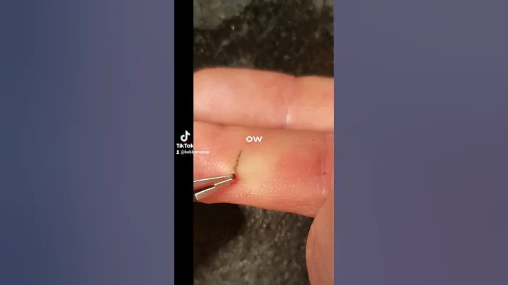 Satisfying splinter removal