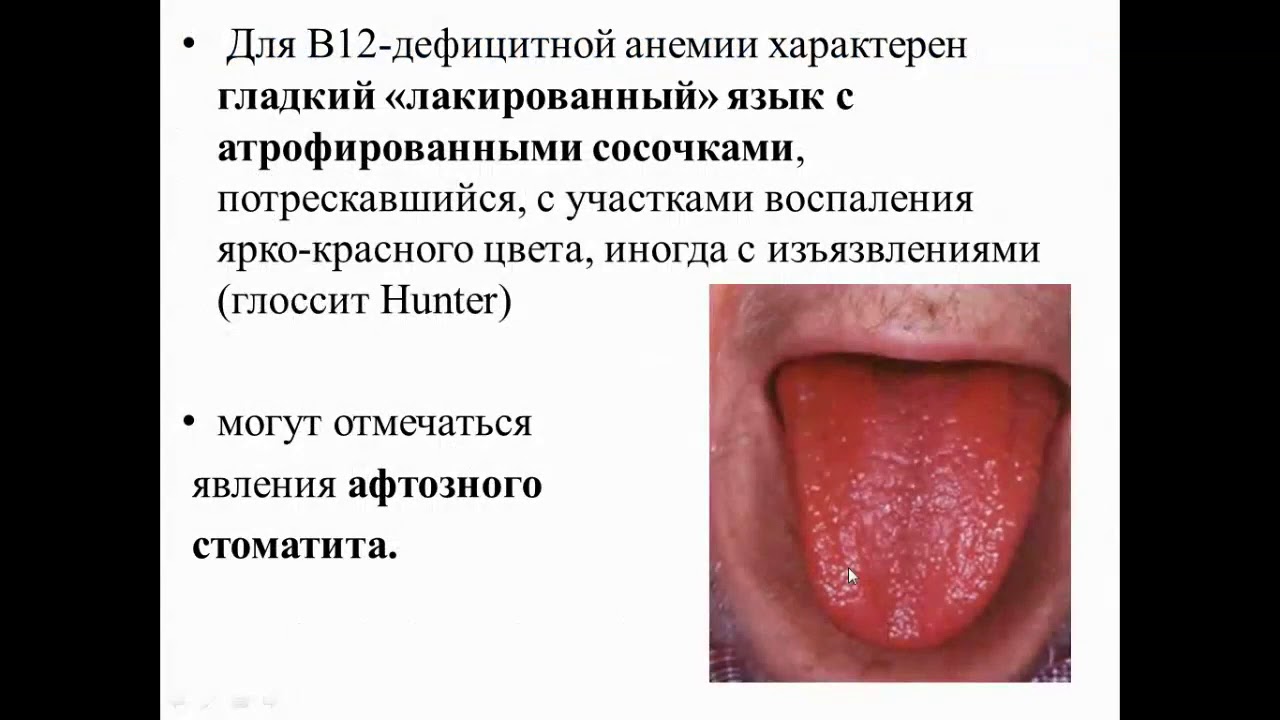 Образовательный вебинар 'Дефицит витамина B12 у пациентов с сердечно ...