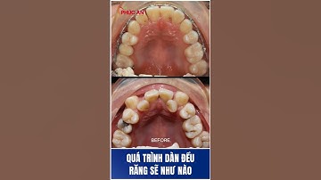 Quy trình dàn đều răng bằng mắc cài Kim loại 3M