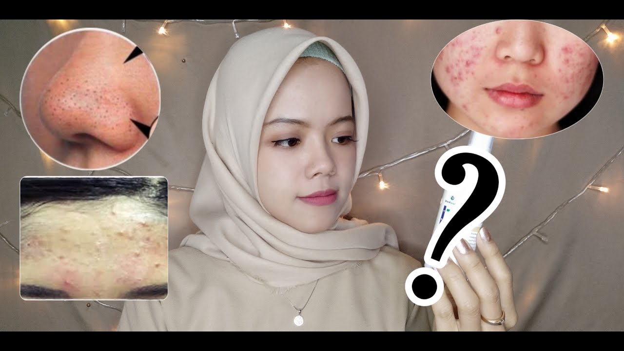 mengatasi jerawat, bruntusan, komedo dan semua masalah kulit lainnya