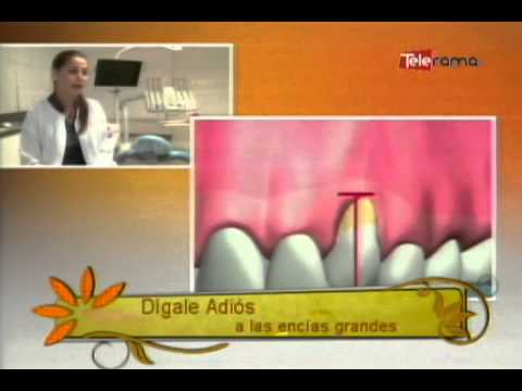 Dígale adiós a las encías grandes