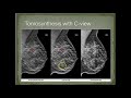 RADT 221 Mammography