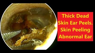 Thick Dead Skin Ear Peels - Skin Peeling Abnormal Ear 2023-11-30 #relaxing #satisfying #asmr