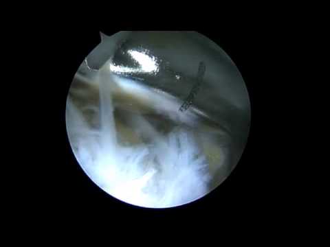 Epicondylite Tennis elbow - Arthroscopic treatment - Dr Falcone Clinique Jouvenet