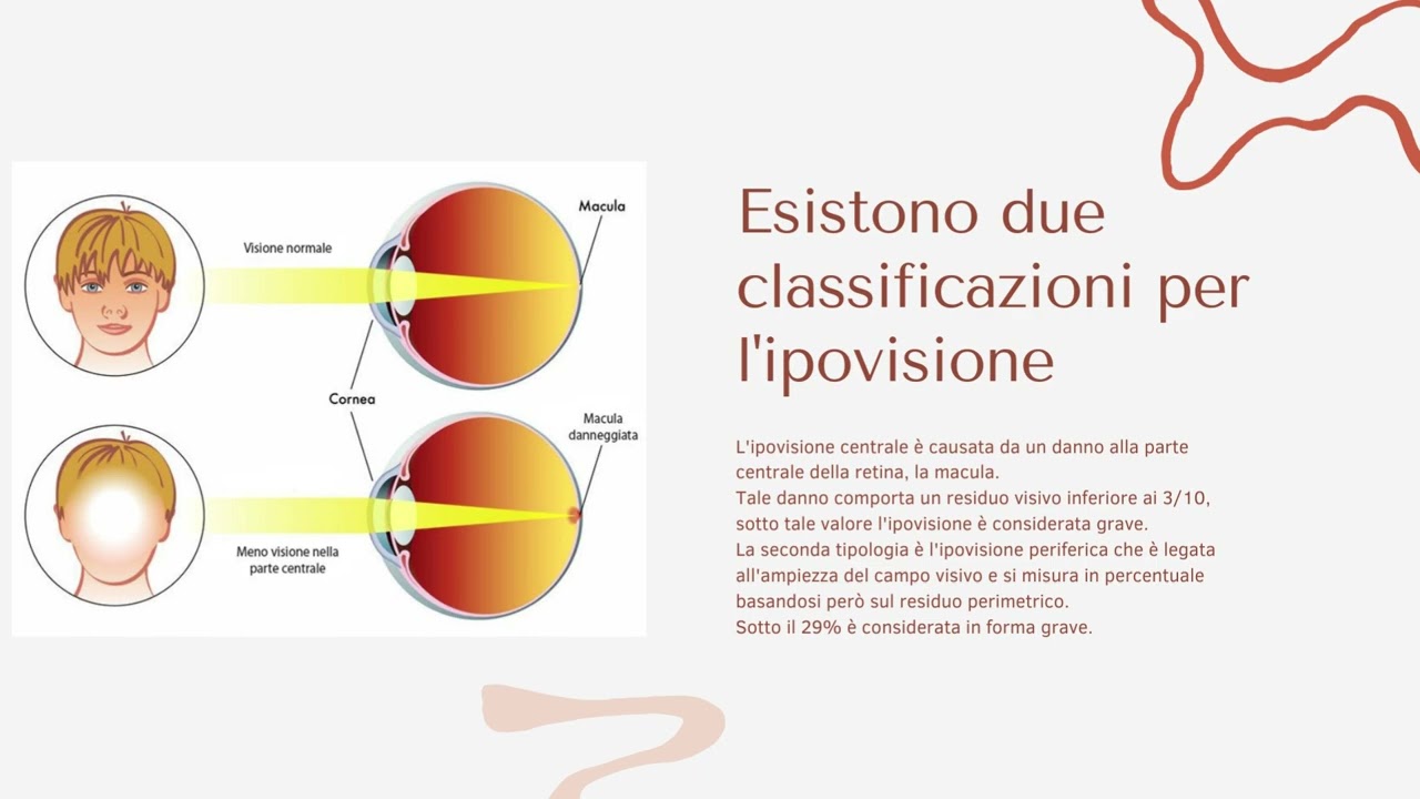Che cos'è l'ipovisione? ottica Napoli dieci decimi