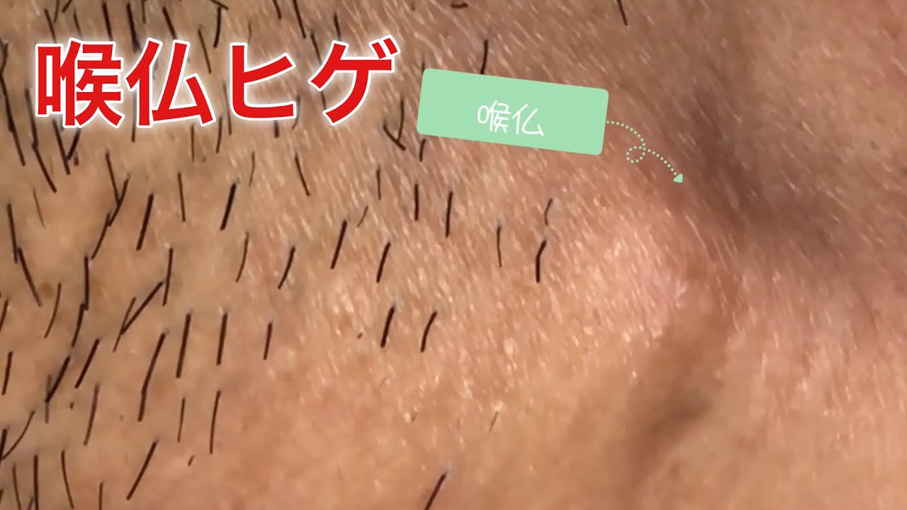 ヒゲ抜き マスクしててもはみ出る喉仏ヒゲをきれいに抜く Youtube ヒゲ抜き マスクしててもはみ出る喉仏ヒゲをきれいに抜く Youtube