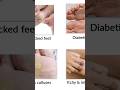 Dry And Itchy Crack Heels Repair || Sukhe aur itchy cracked heels ke liye best #shorts #heelrepair