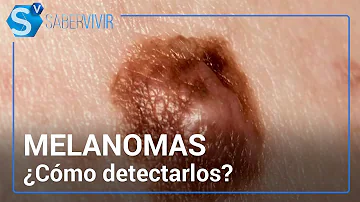 ¿Qué aspecto tiene un melanoma precanceroso?