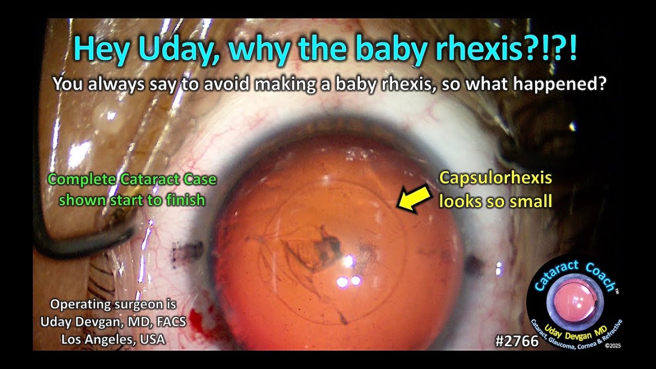 Small Rhexis CataractCoach™ 2766: Hey Uday, why the baby rhexis?!?! - YouTube