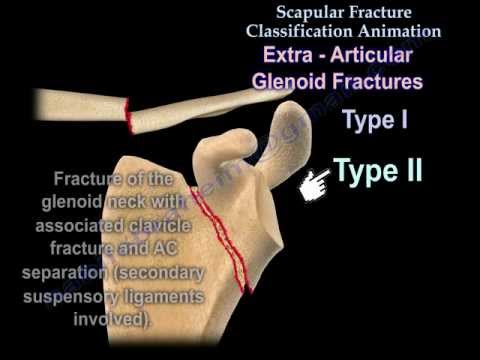 Scapular Fracture Classification Animation - Everything You Need To Know - Dr. Nabil Ebraheim