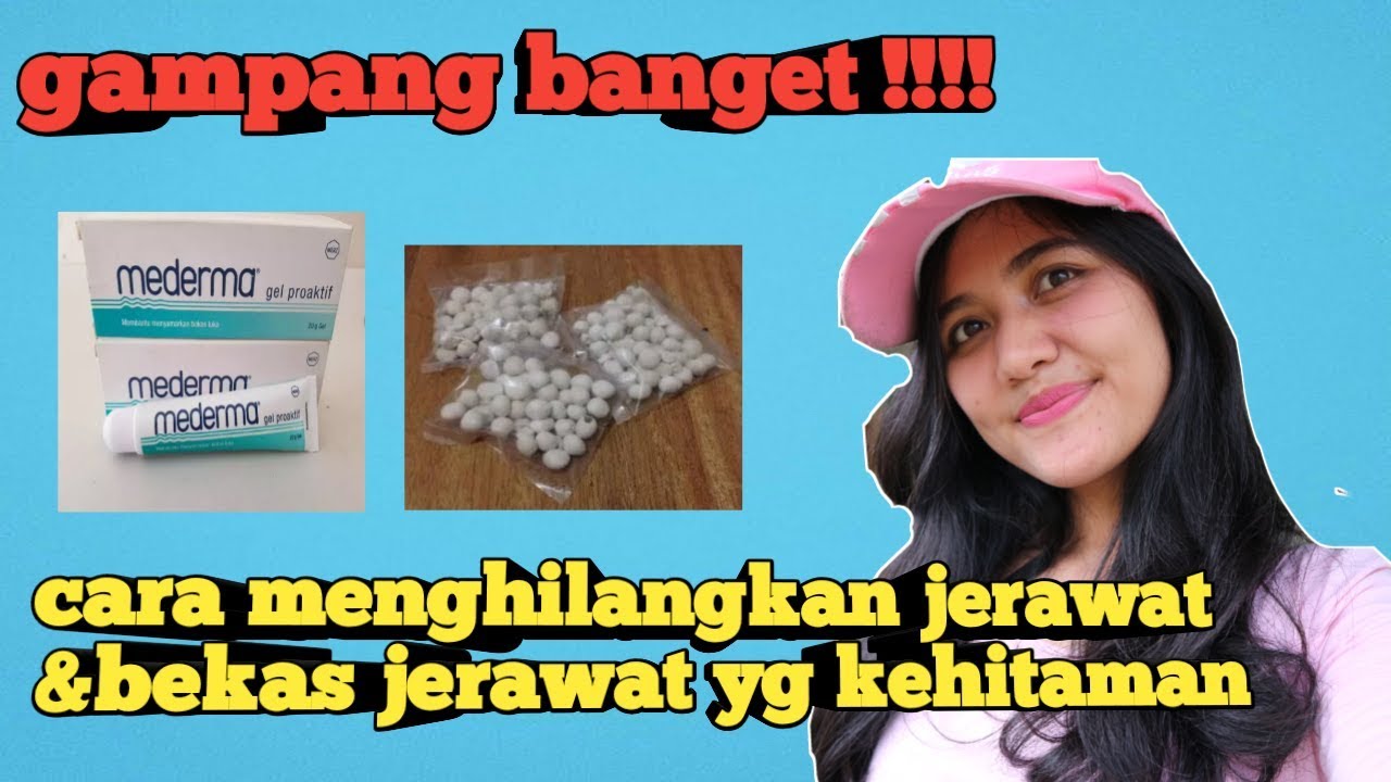 CARA MENGHILANGKAN JERAWAT & BEKAS JERAWAT YG KEHITAMAN !!! 