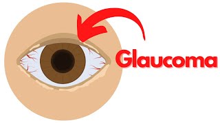 What is GLAUCOMA? (Symptoms, Causes, Treatment, Prevention)