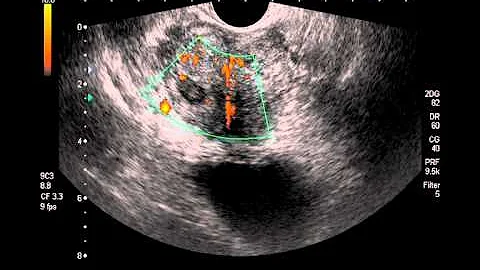 Come si chiama il tumore benigno alla prostata?