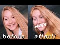 getting my braces off after 2.5 years!!