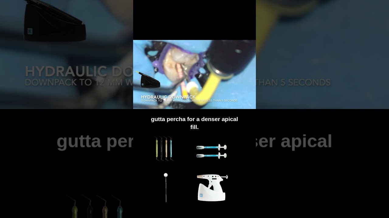 RCT #30 Hybrid Hydraulic Obturation