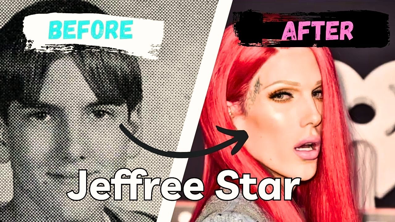 Jeffree Star Forehead Surgery