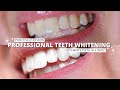 PROFESSIONAL TEETH WHITENING | 360 Whitening Home Day Kit | Process &amp; Review