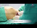 Breast augmentation | Highly cohesive nanotextured implant | by Dr. Kaushik | Olmec