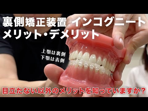 裏側矯正装置】舌側傾斜に有効？どんな先生でも上手くいく？裏側の