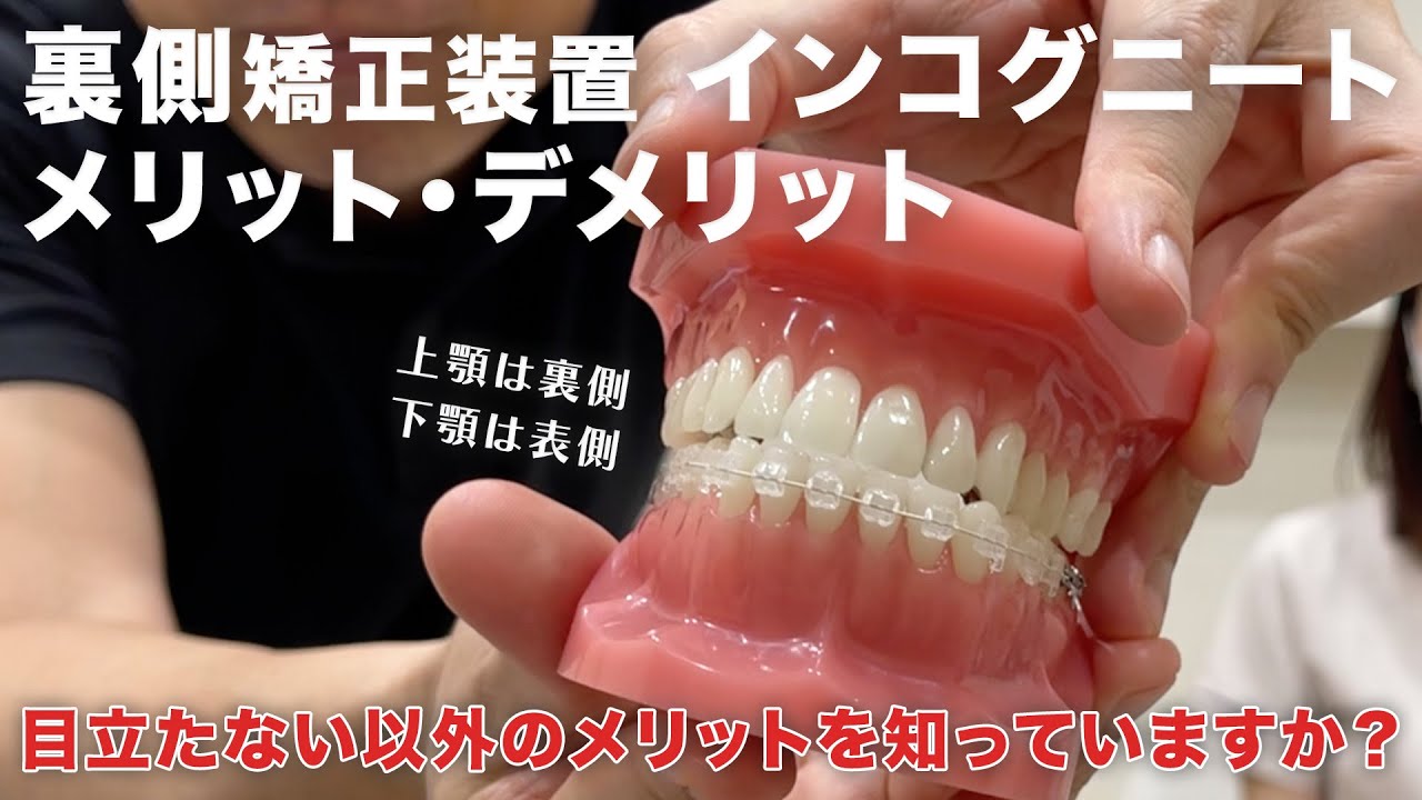 裏側矯正装置】舌側傾斜に有効？どんな先生でも上手くいく？裏側の
