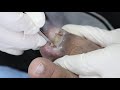 Ep_2576 Ingrown toenail removal 👣 น้องยัดสำลีได้เก่งมาก 😷 (This clip is from Thailand)