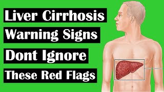 LIVER CIRRHOSIS   WARNING SIGNS, DONT IGNORE THESE RED FLAGS , CHRONIC LIVER DISEASE , FATTY LIVER