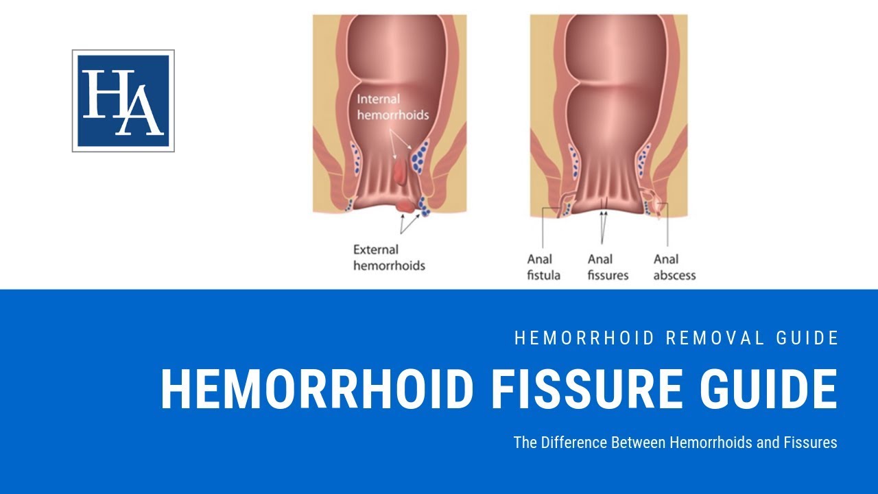 Hemorrhoid Fissure Guide The Difference Between Hemorrhoids And