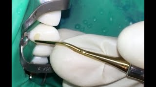 Class V Resin Composite Cavity Preparation & Restoration