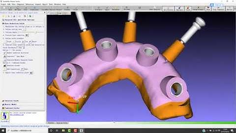 Bone reduction guide