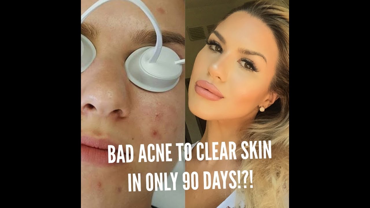 HOW I WENT FROM CYSTIC ACNE TO CLEAR SKIN IN ONLY 90 DAYS!! - YouTube