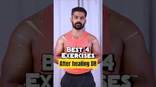 Diastasis Recti Recovery Complete? Next Safe Exercises You Must Start