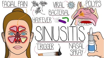 Understanding Sinusitis