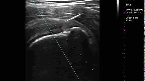 Stem Cells Study for partial thickness rotator cuff tear
