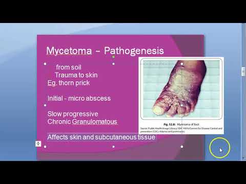 Video: What Is Mycetoma