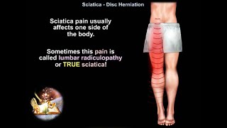 Low back pain, Sciatica, Disc Herniation - Everything You Need To Know - Dr. Nabil Ebraheim