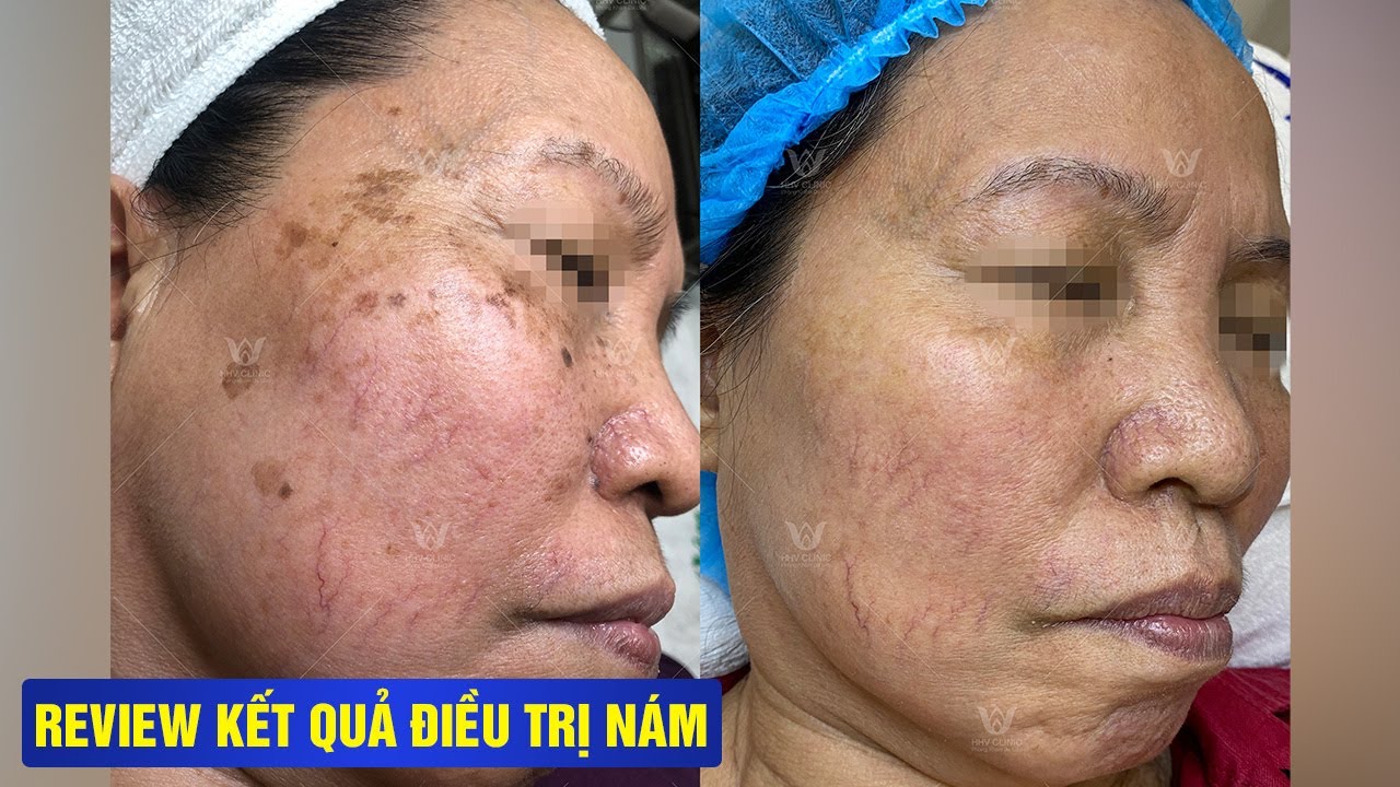 REVIEW KẾT QUẢ ĐIỀU TRỊ NÁM THÀNH CÔNG - SAU 3 NĂM CÔ QUAY TRỞ LẠI HHV CLINIC - KHÔNG TÁI NÁM.