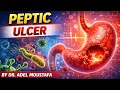 peptic ulcer-internal medicine-DU